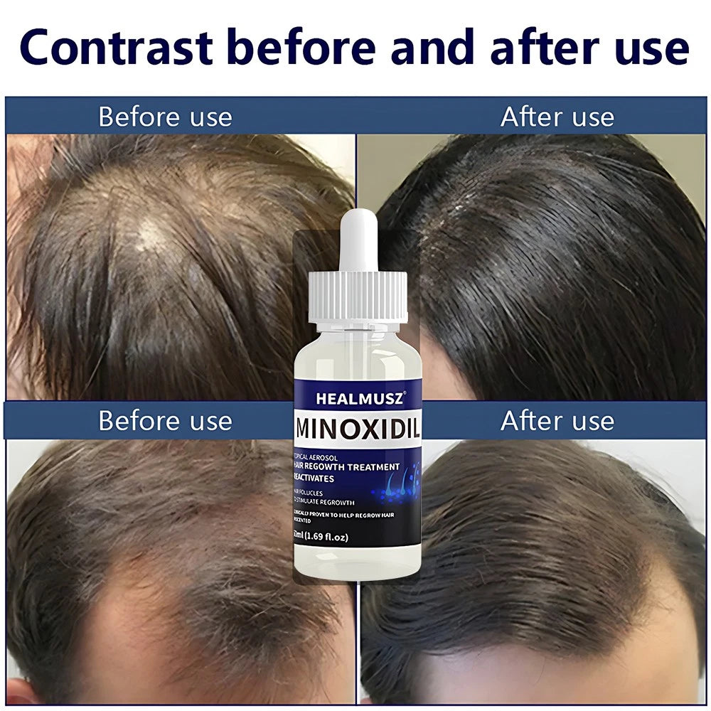 Topical Minoxidil 5%